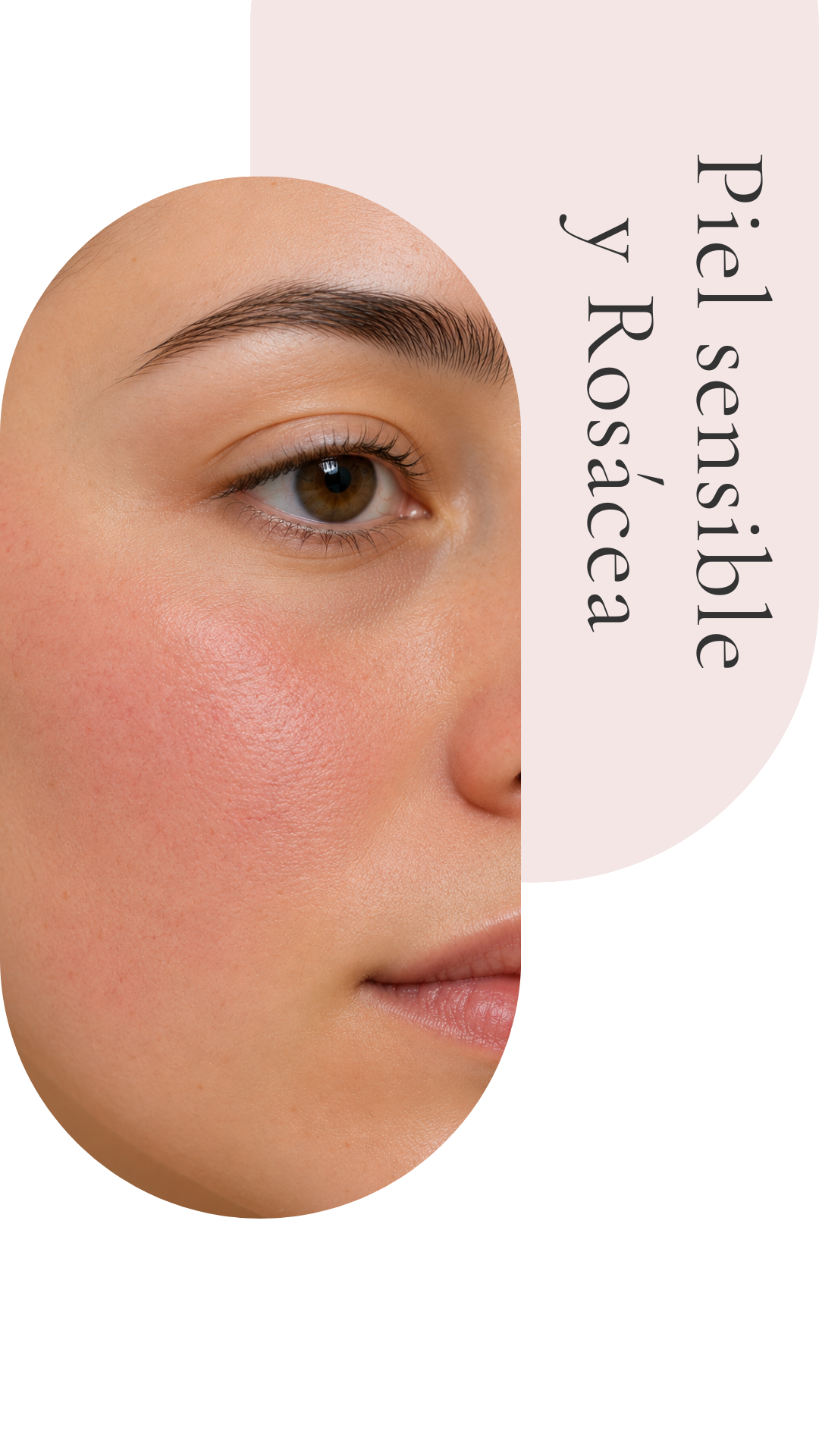 piel sensible y rosacea